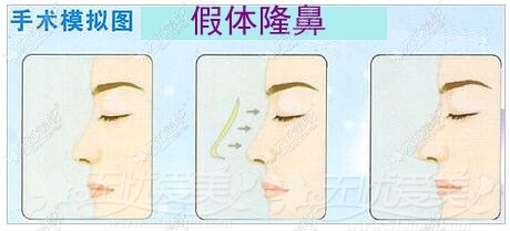 东莞知美整形做假体隆鼻多少钱呢
