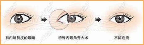 大连沙医生开眼角手术