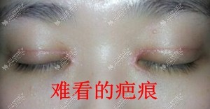 开眼角疤痕