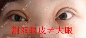 割双眼皮效果不好