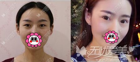 南京连天美美杜莎眼综合案例