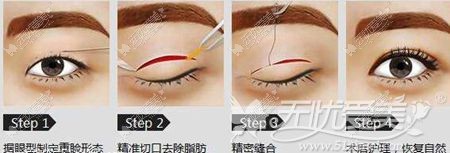 南宁连天美美杜莎眼综合的手术方法