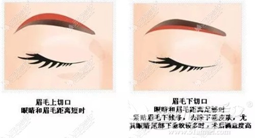 鄂尔多斯百达丽切眉手术