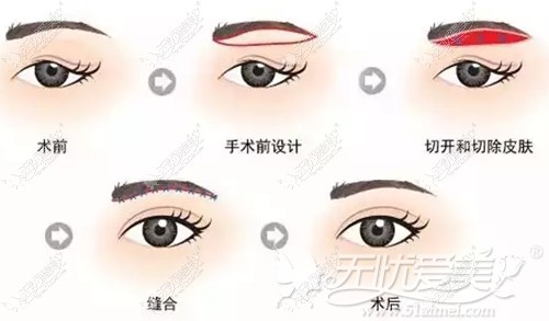 鄂尔多斯百达丽切眉手术过程