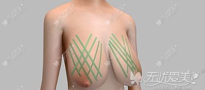 不开刀人工韧带提升术的原理
