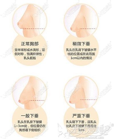 胸部下垂的不同程度