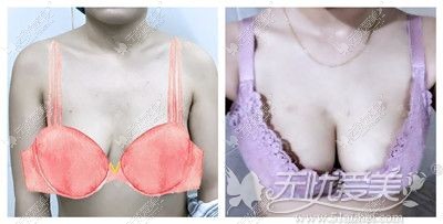 韩啸院长人工韧带提升术的效果前后对比