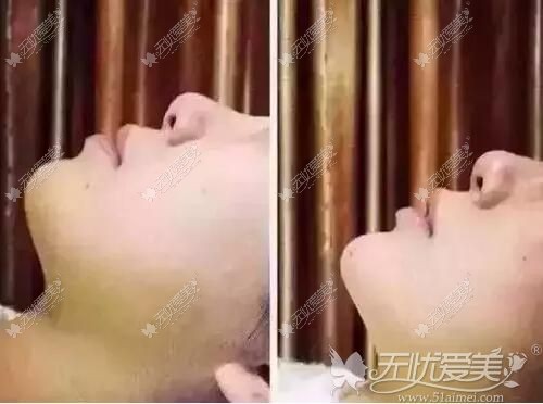 自体脂肪填充下巴对比案例