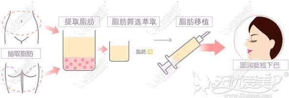 自体脂肪丰下巴原理