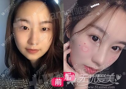 长沙雅美双眼皮<span style=