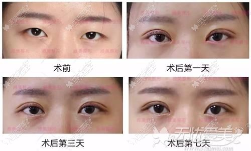 长沙雅美翘睫双眼皮<span style=