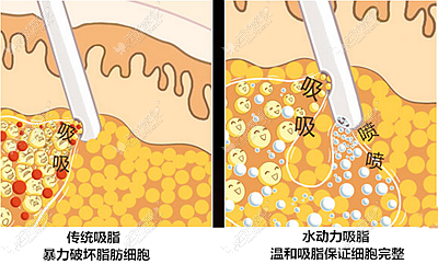 水动力小腿分层溶脂和传统吸脂的区别
