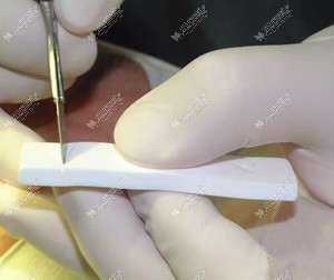 膨体隆鼻