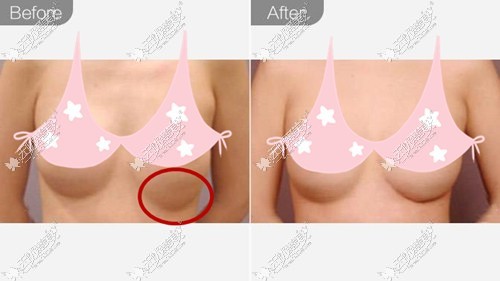 黄名斗隆胸失败修复效果图