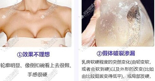 假体隆胸失败的症状