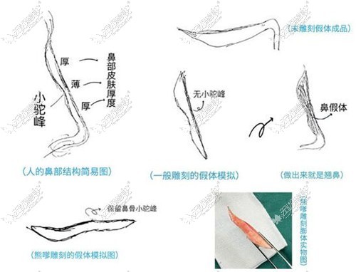 熊宜文做鼻子会保留驼峰鼻
