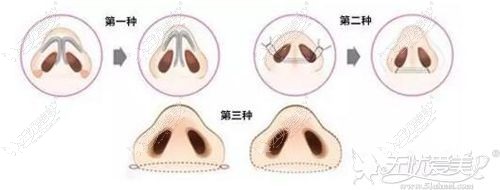 缩小鼻翼的三种方法