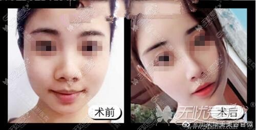 鼻翼缩小前后对比案例