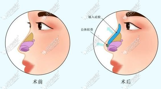 长沙雅美做鼻子好的医生