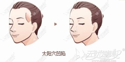 玻尿酸填充太阳穴效果