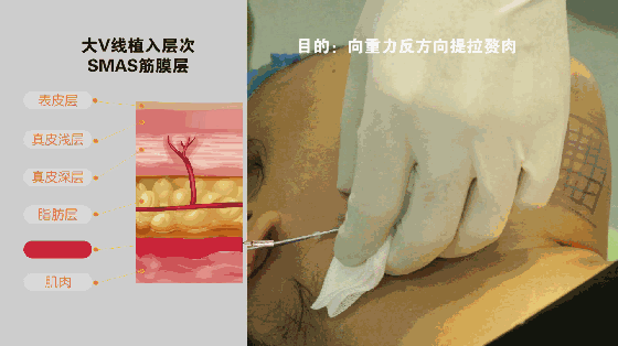 大V线的埋线操作