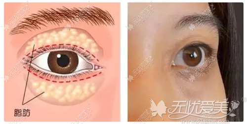眼袋的形成是眶下脂肪过多造成的