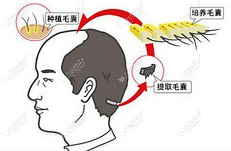 芜湖壹加壹植发贵吗 成活率高吗