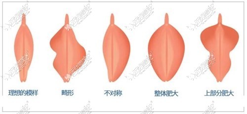 几种常见的阴唇肥大问题