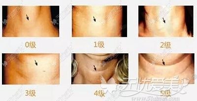 我们颈纹的深浅等级