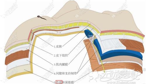 骨水泥填充到颅顶的位置