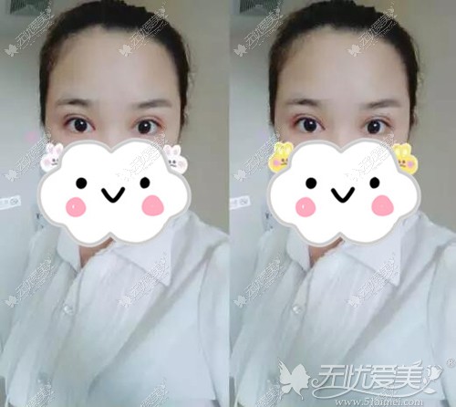 廉锋医生双眼皮案例