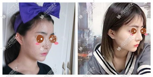 刘溪主任的耳软骨隆鼻案例
