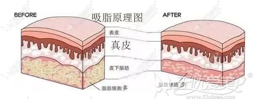 吸脂手术的原理 吸脂手术的原理