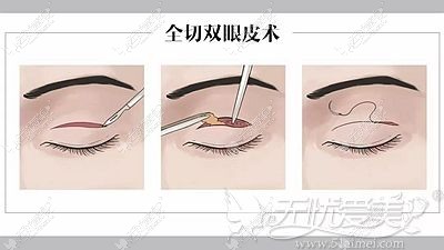 全切双眼皮手术过程