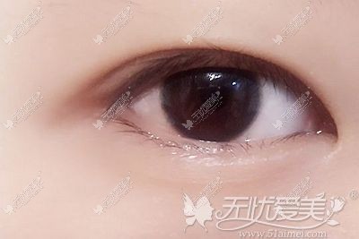 内双可以通过双眼皮手术让眼睛重新变大