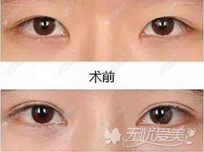 扬州艾菲斯双眼皮手术案例