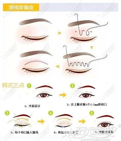 埋线和韩式三点双眼皮手术解析