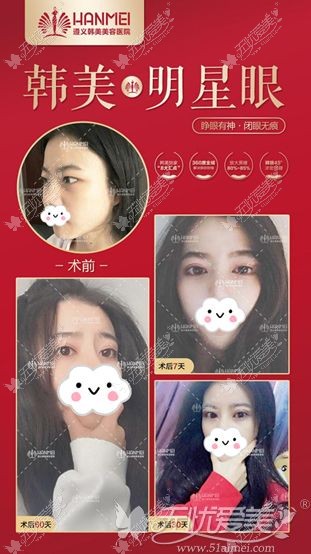 韩美明星综合美眼术真实案例