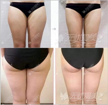 王志军大腿吸脂案例 王志军大腿吸脂案例