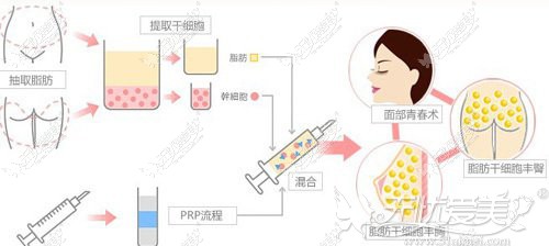 自体脂肪提取过程