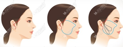 轻度的皮肤松弛与皱纹