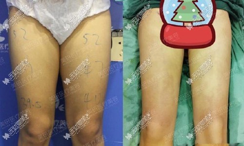 长沙美研大腿吸脂前后对比图