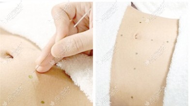 成都驻颜埋线减肥
