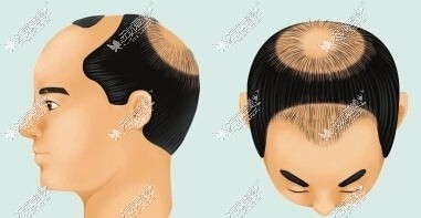 头顶稀疏的样子
