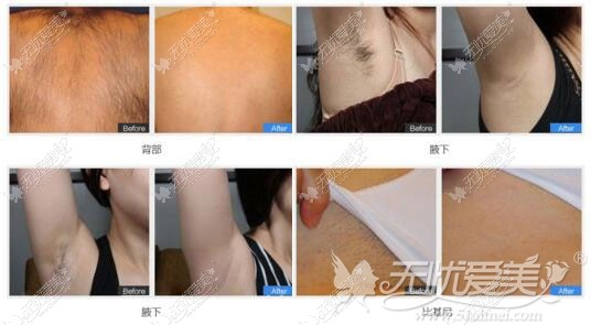 商丘欧兰整形冰点脱毛效果 商丘欧兰整形冰点脱毛效果