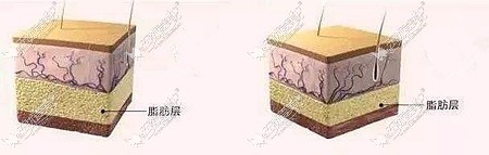腹部吸脂需要看脂肪层厚度