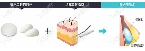 韩国TL整形医院复合隆胸术