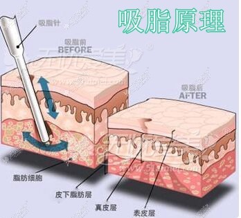 石家庄天宏整形吸脂手术原理