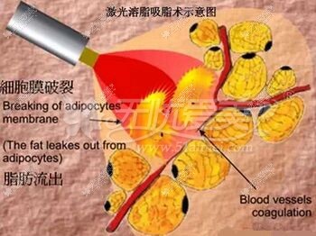 石家庄天宏整形激光溶脂