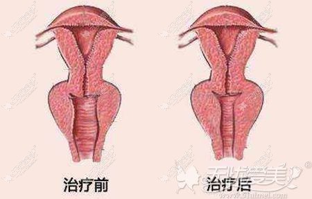 瑞韩自体脂肪缩阴术效果